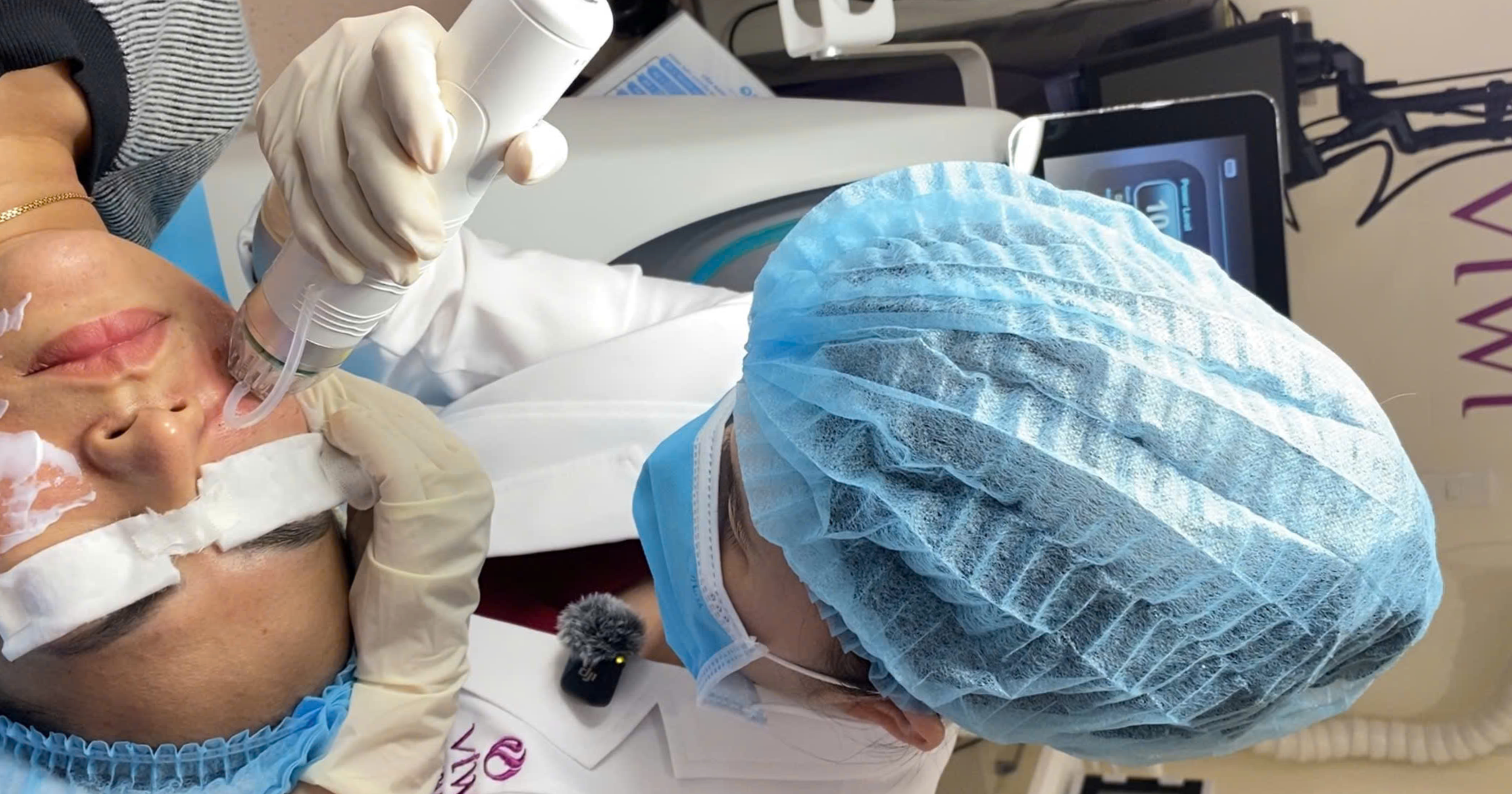 RF Needle có đau không và có bị thâm không?