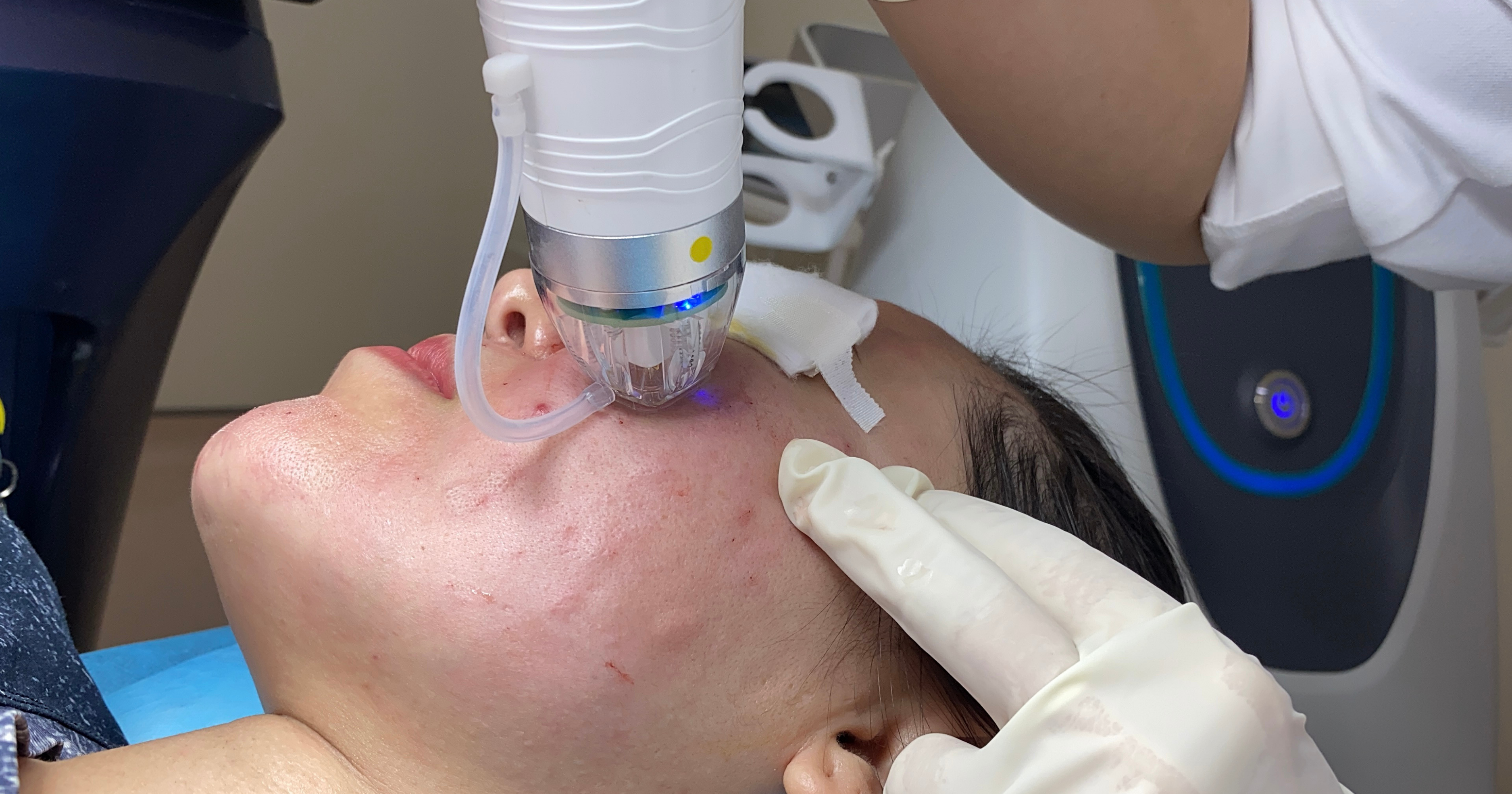 RF Needle có đau không và có bị thâm không?