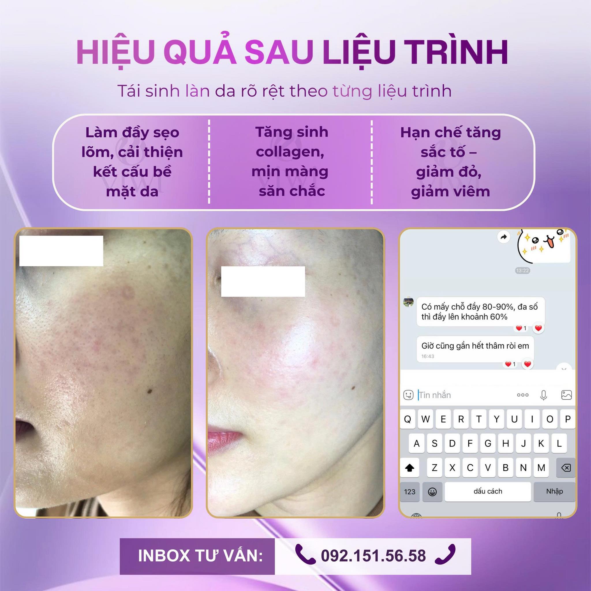 RF Needle có đau không và có bị thâm không