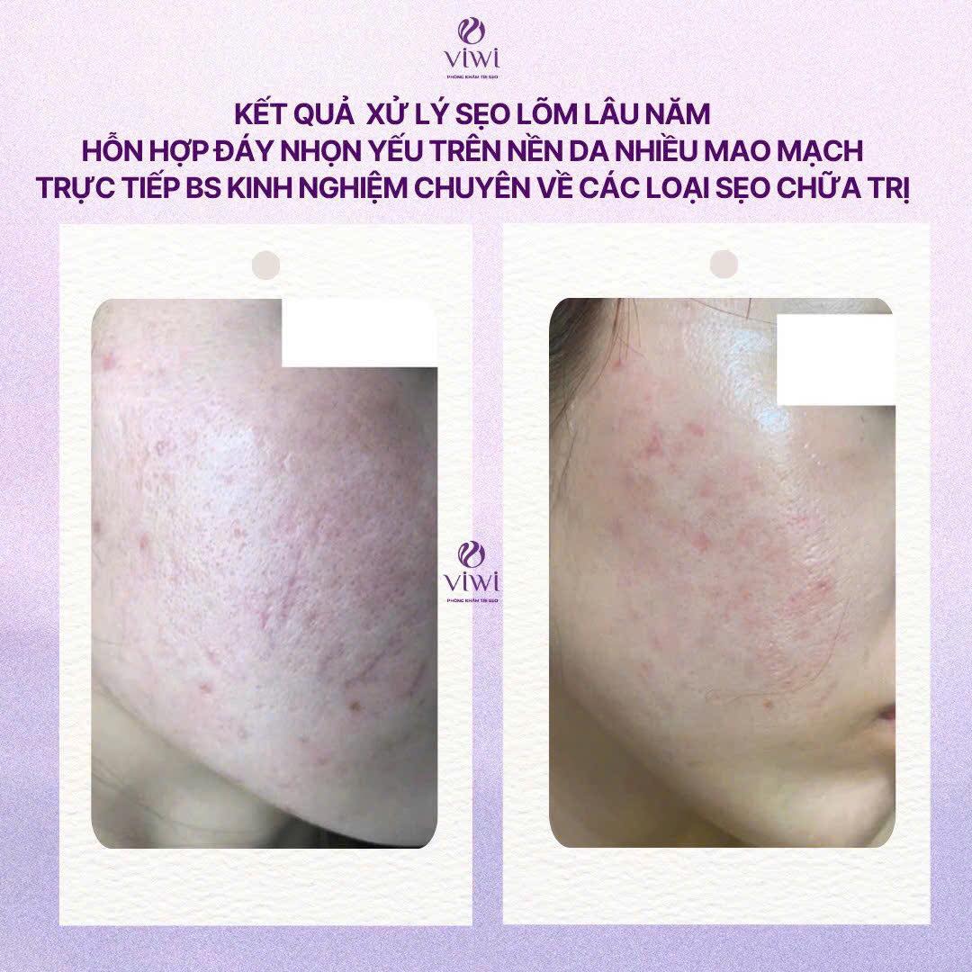 RF Needle có đau không và có bị thâm không