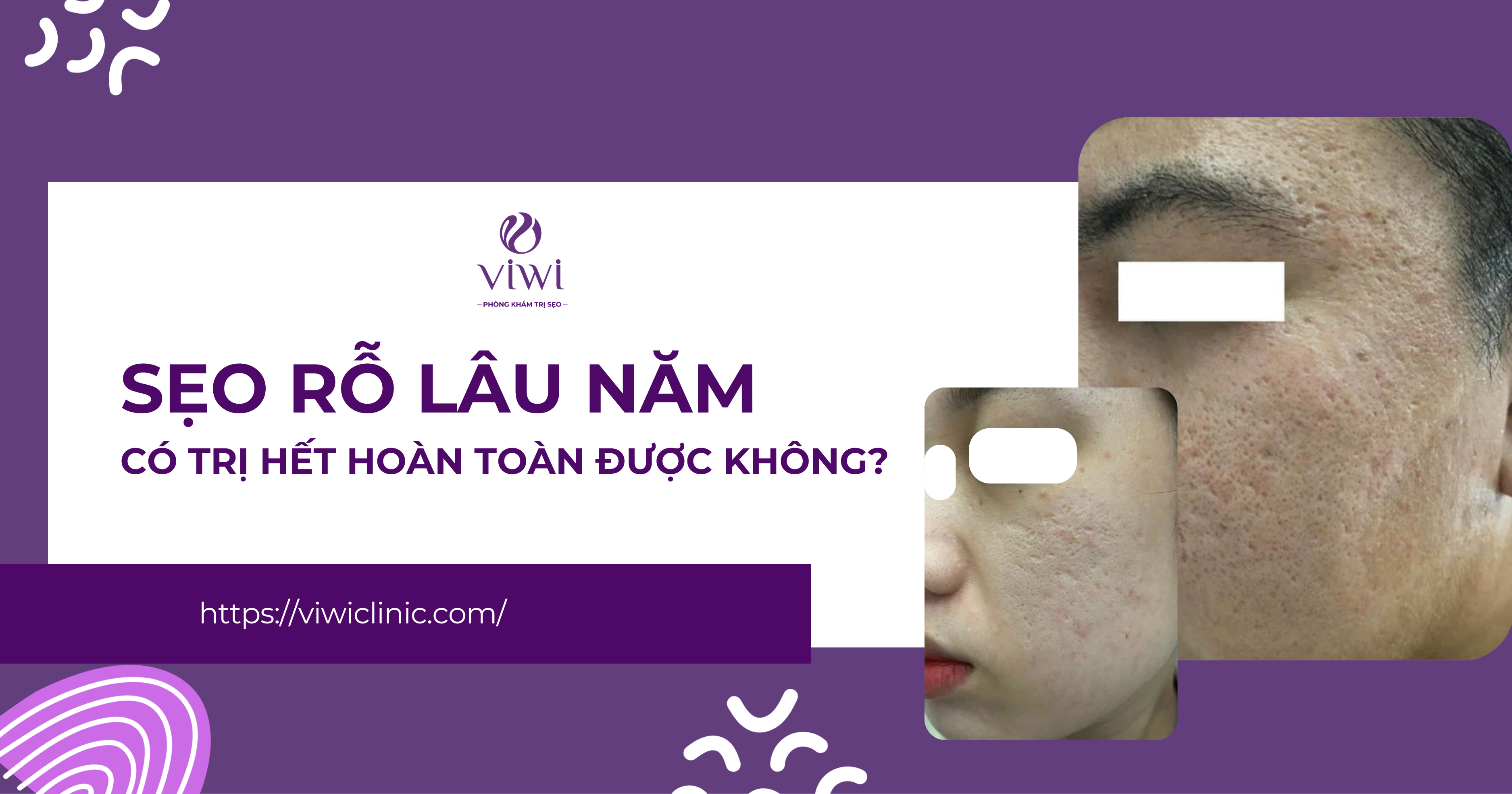 Sẹo Rỗ Lâu Năm Có Trị Hết Hoàn Toàn Được Không?