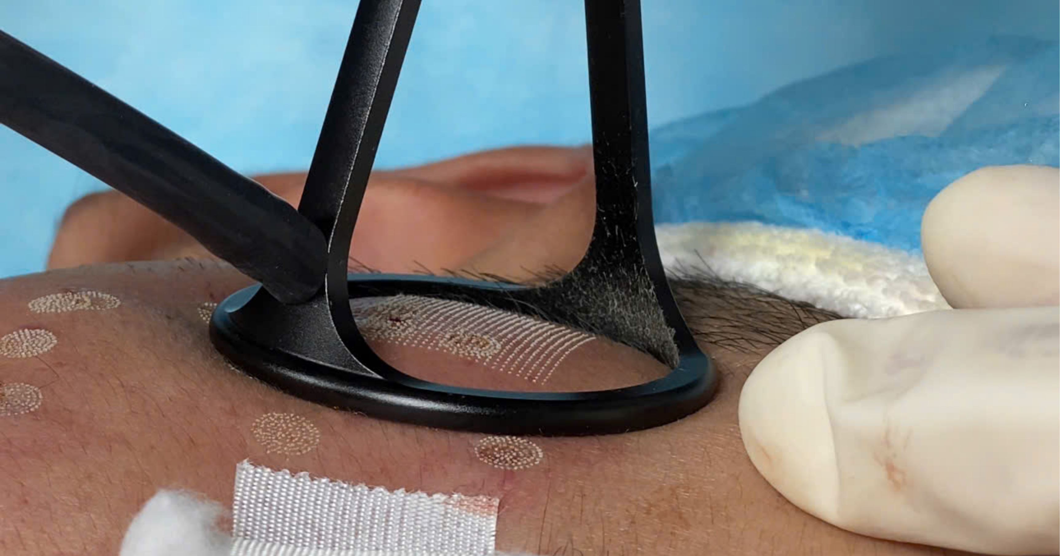 Sẹo rỗ lâu năm có trị hết hoàn toàn được không