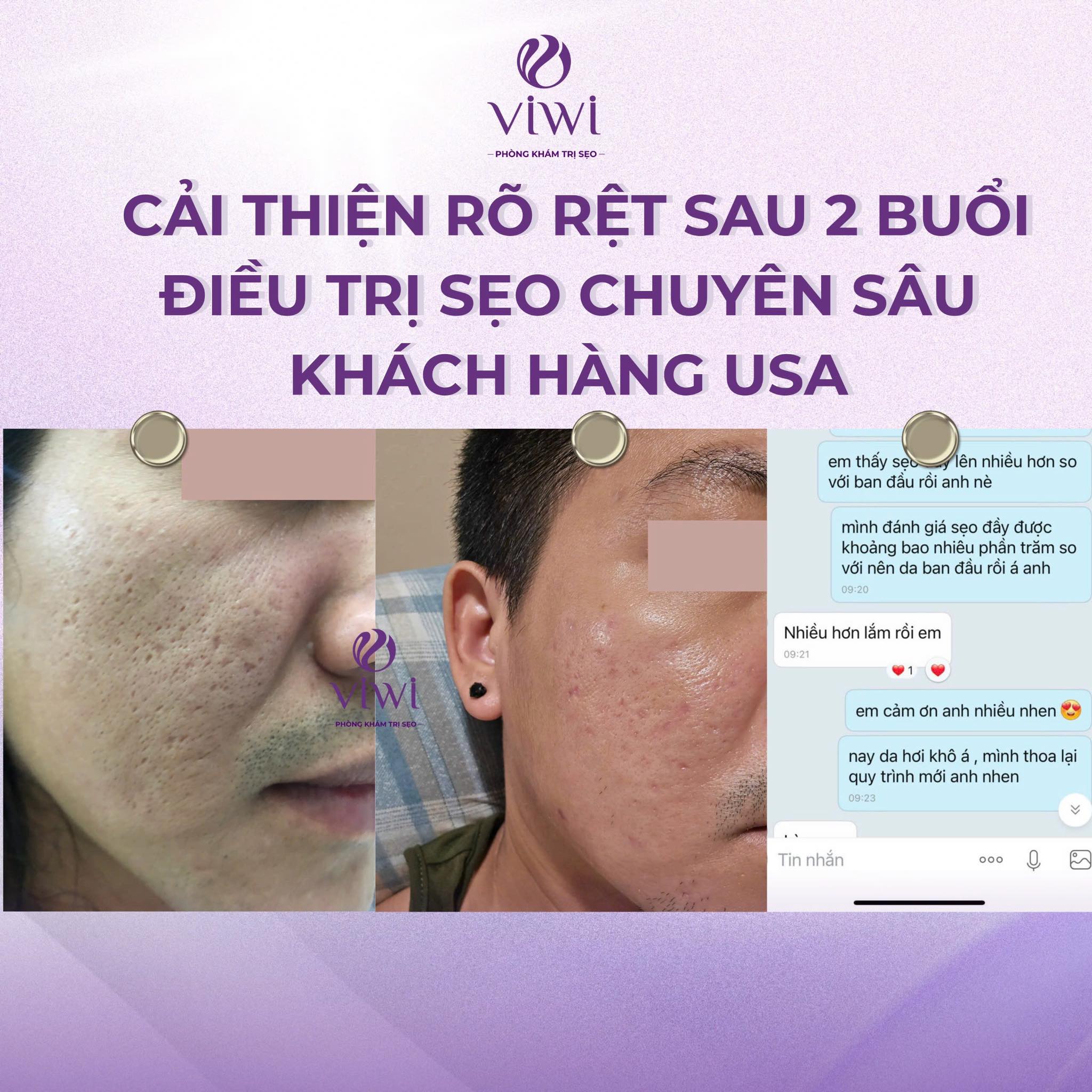 Tách xơ sẹo sâu bao lâu hồi phục có để lại bầm không