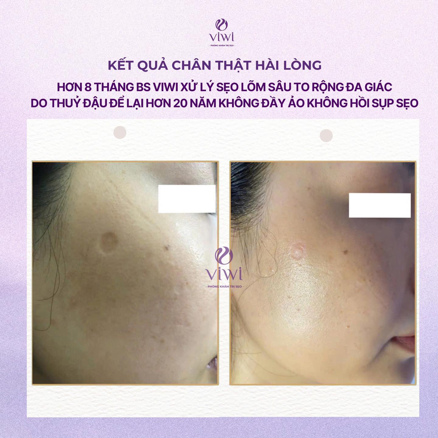 Tách xơ sẹo sâu bao lâu hồi phục có để lại bầm không