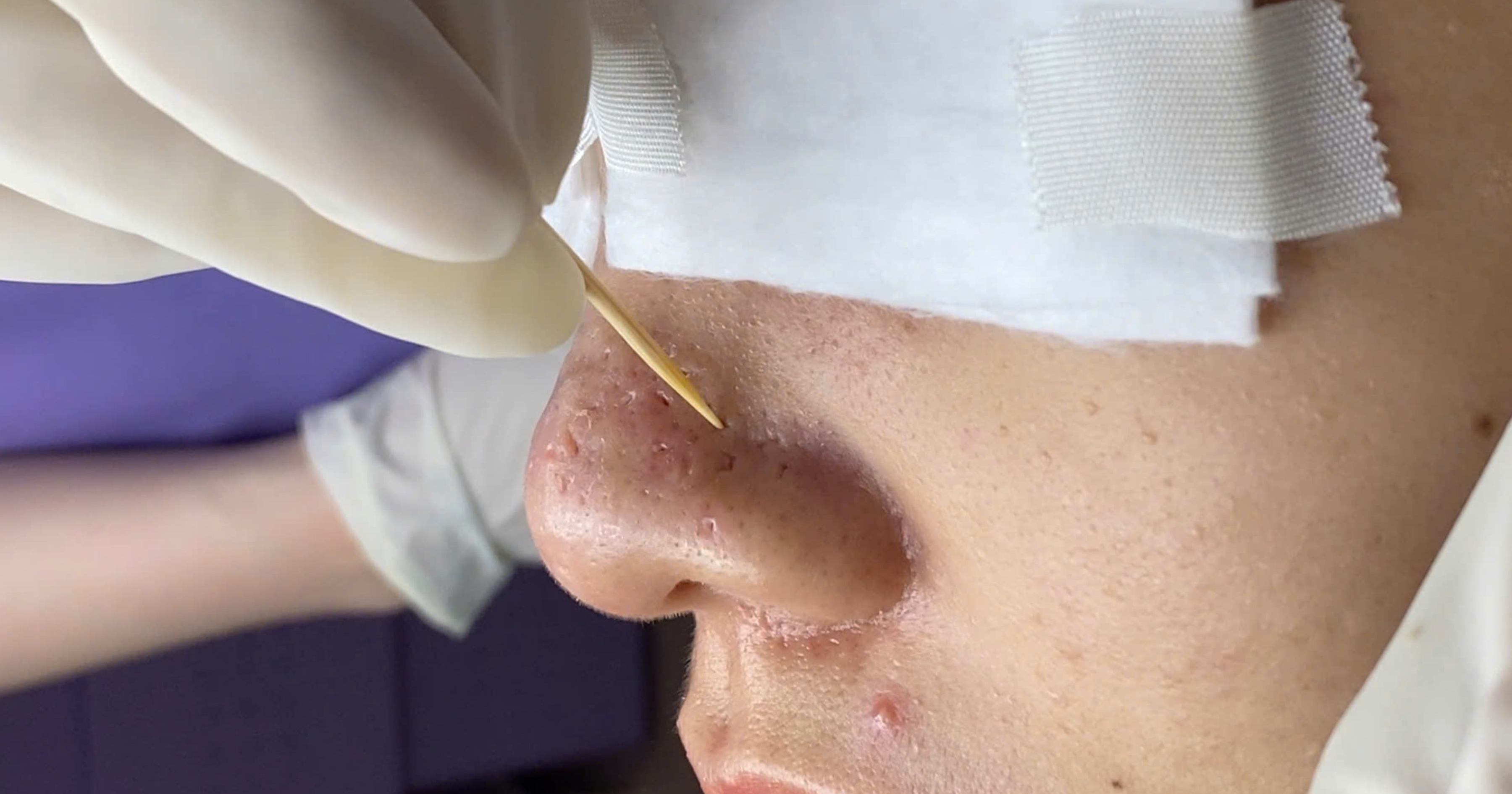 Tca cross trị sẹo lõm có nguy hiểm không có nên làm không