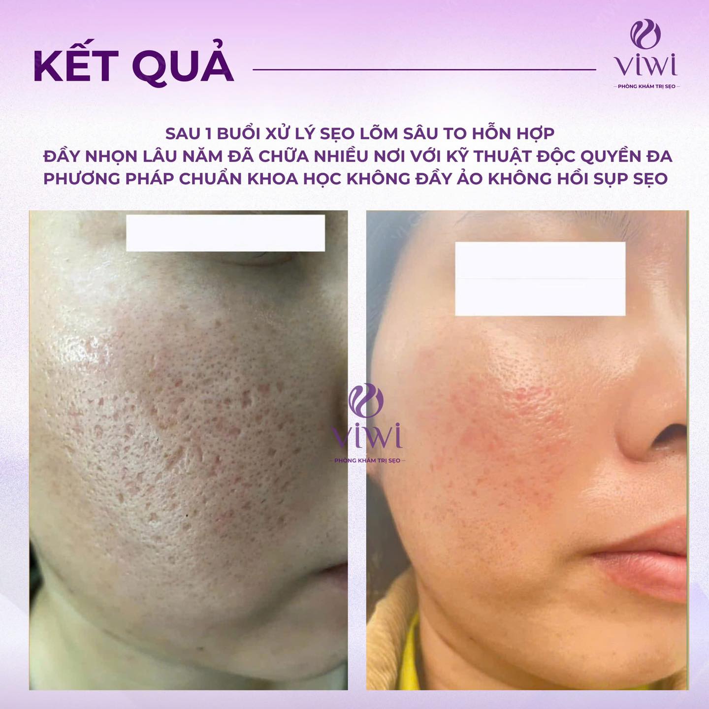 Tca cross trị sẹo lõm có nguy hiểm không có nên làm không