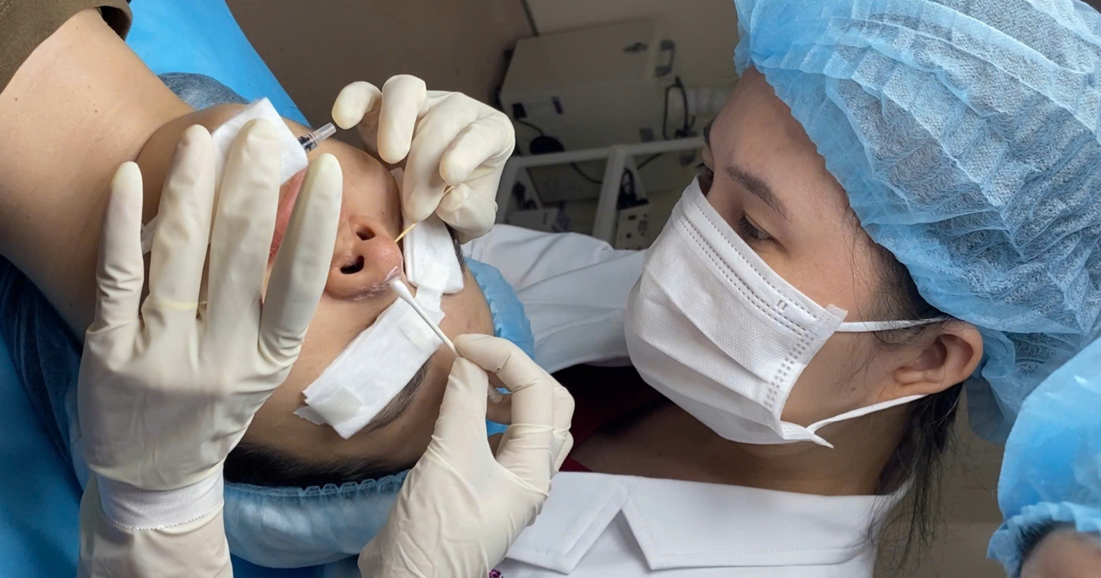 Tca cross trị sẹo lõm có nguy hiểm không có nên làm không