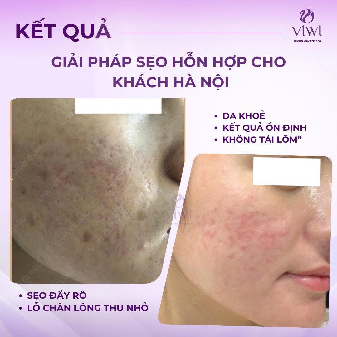 Tca cross trị sẹo lõm có nguy hiểm không có nên làm không