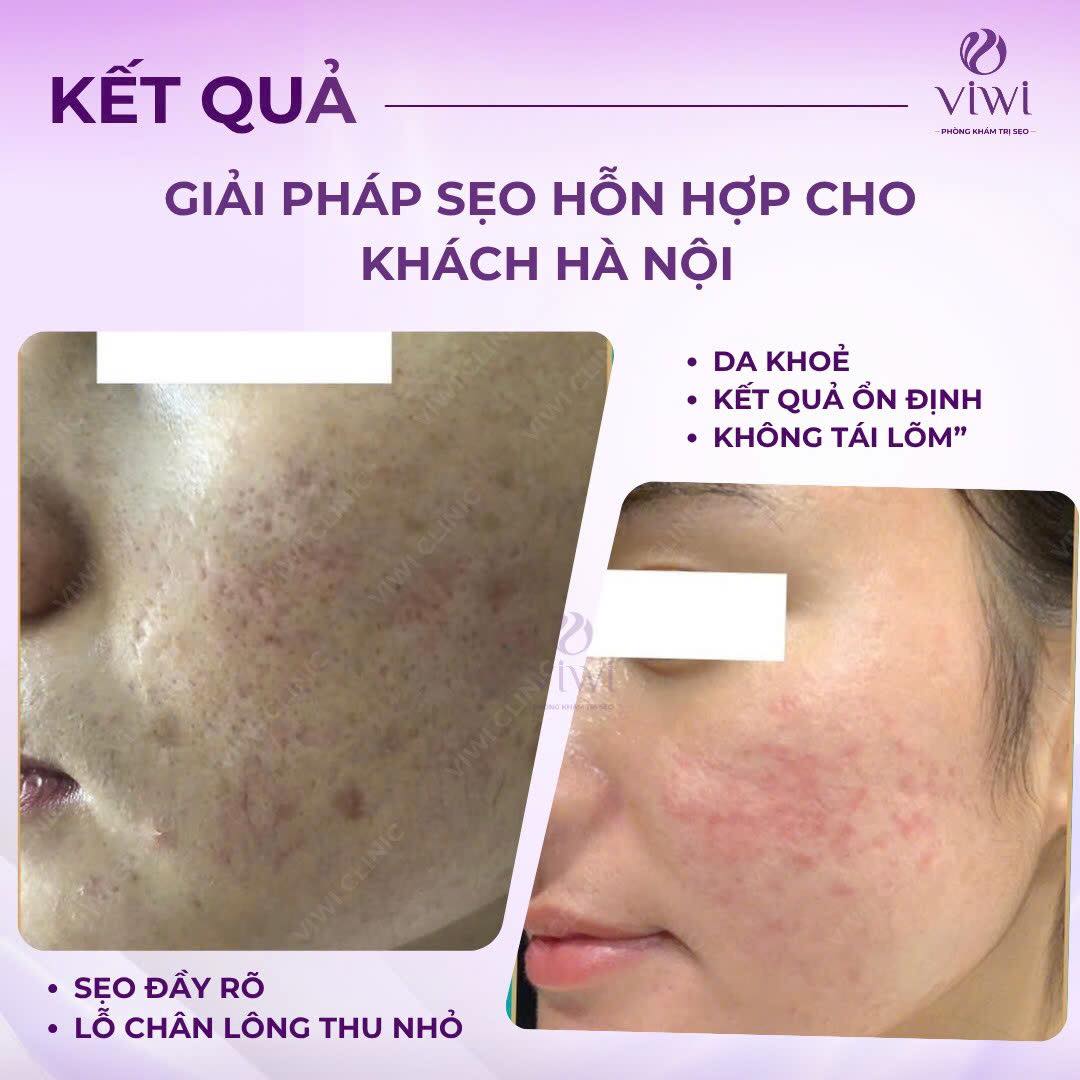 Tca cross trị sẹo lõm có nguy hiểm không có nên làm không