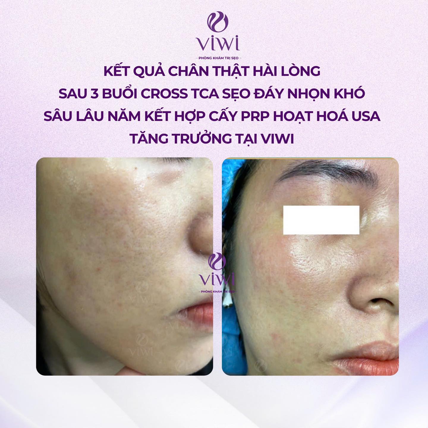 Tca cross trị sẹo lõm có nguy hiểm không có nên làm không