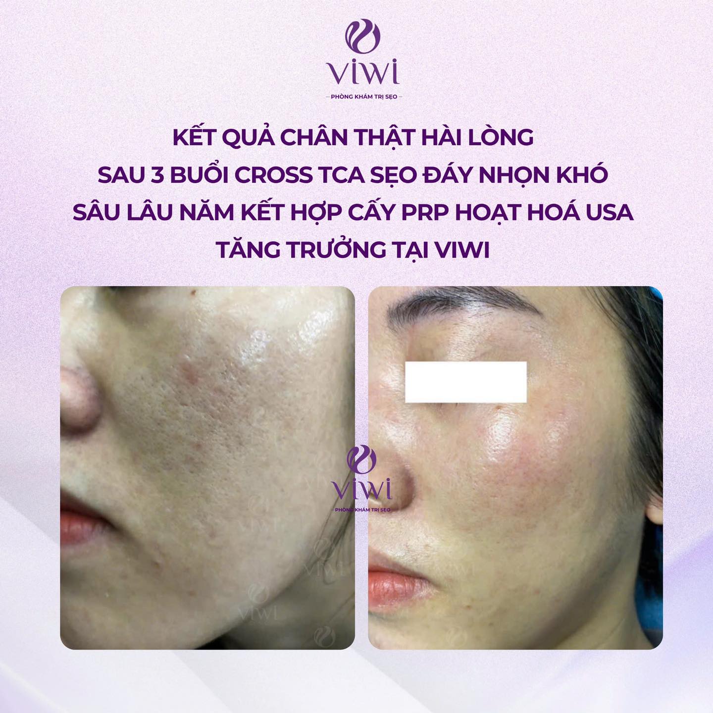 Tca cross trị sẹo lõm có nguy hiểm không có nên làm không