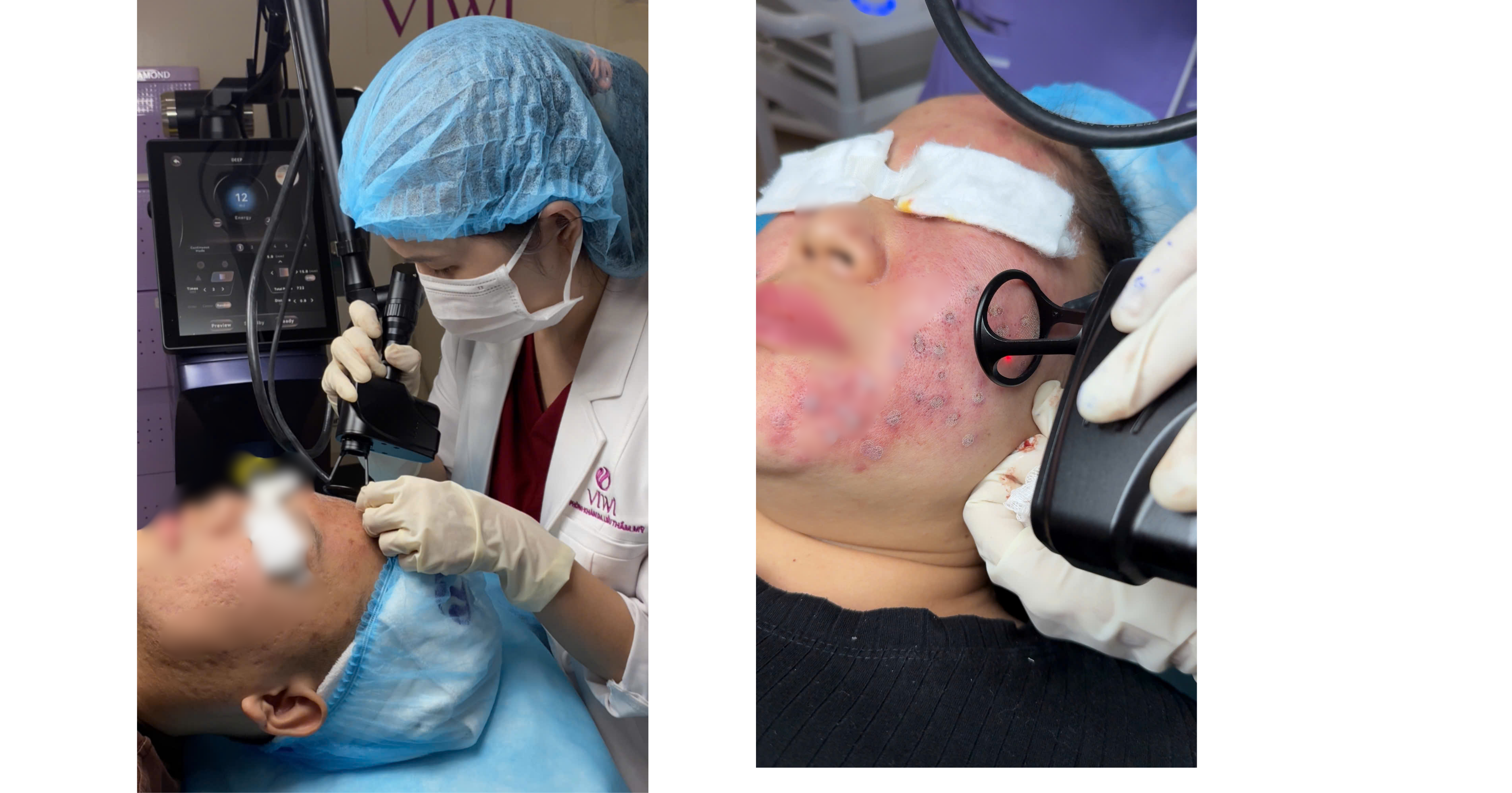 Trị thâm sau mụn nhanh cho da bị sạm lâu ngày