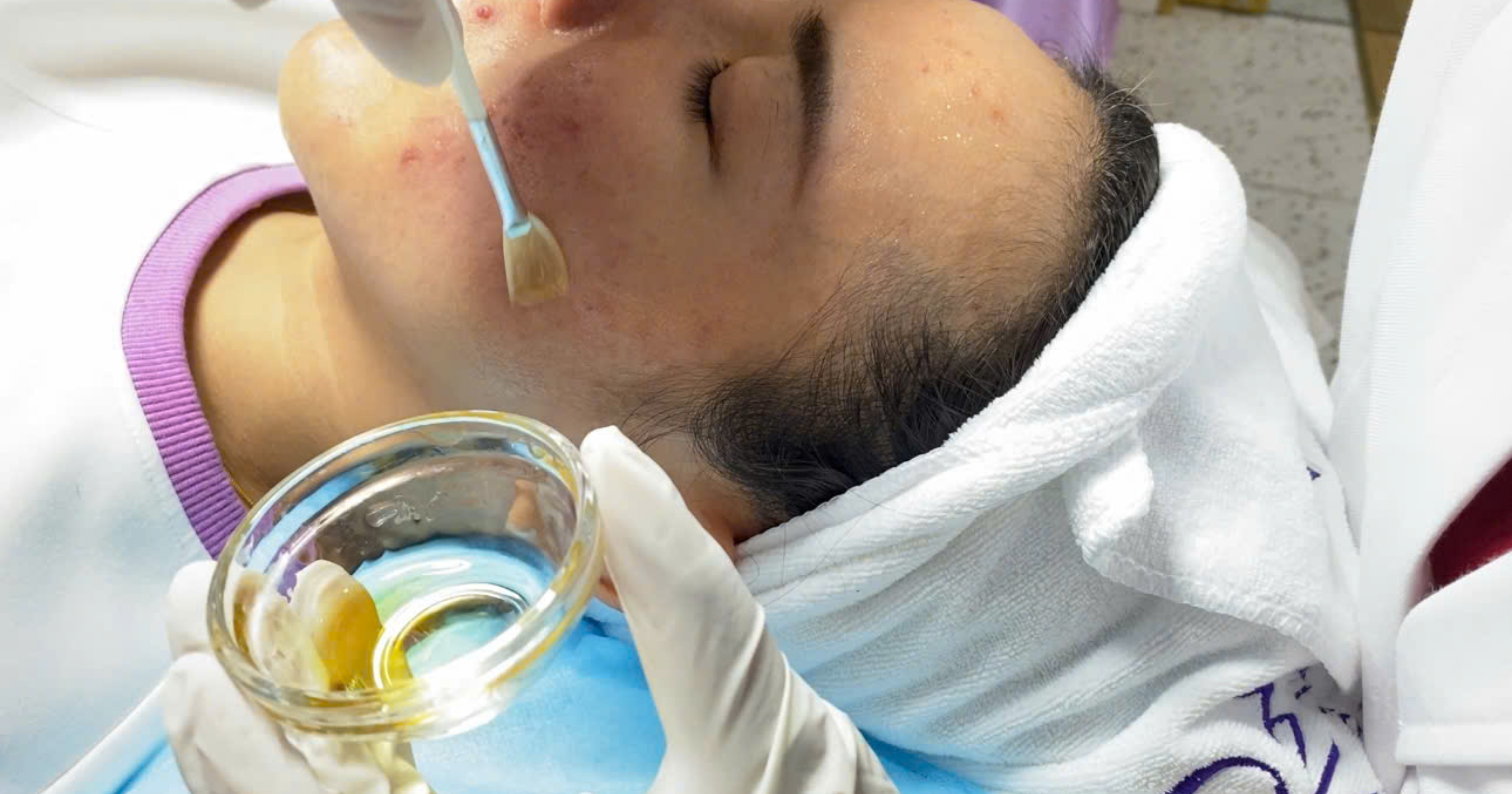 Trị thâm sau mụn nhanh cho da bị sạm lâu ngày