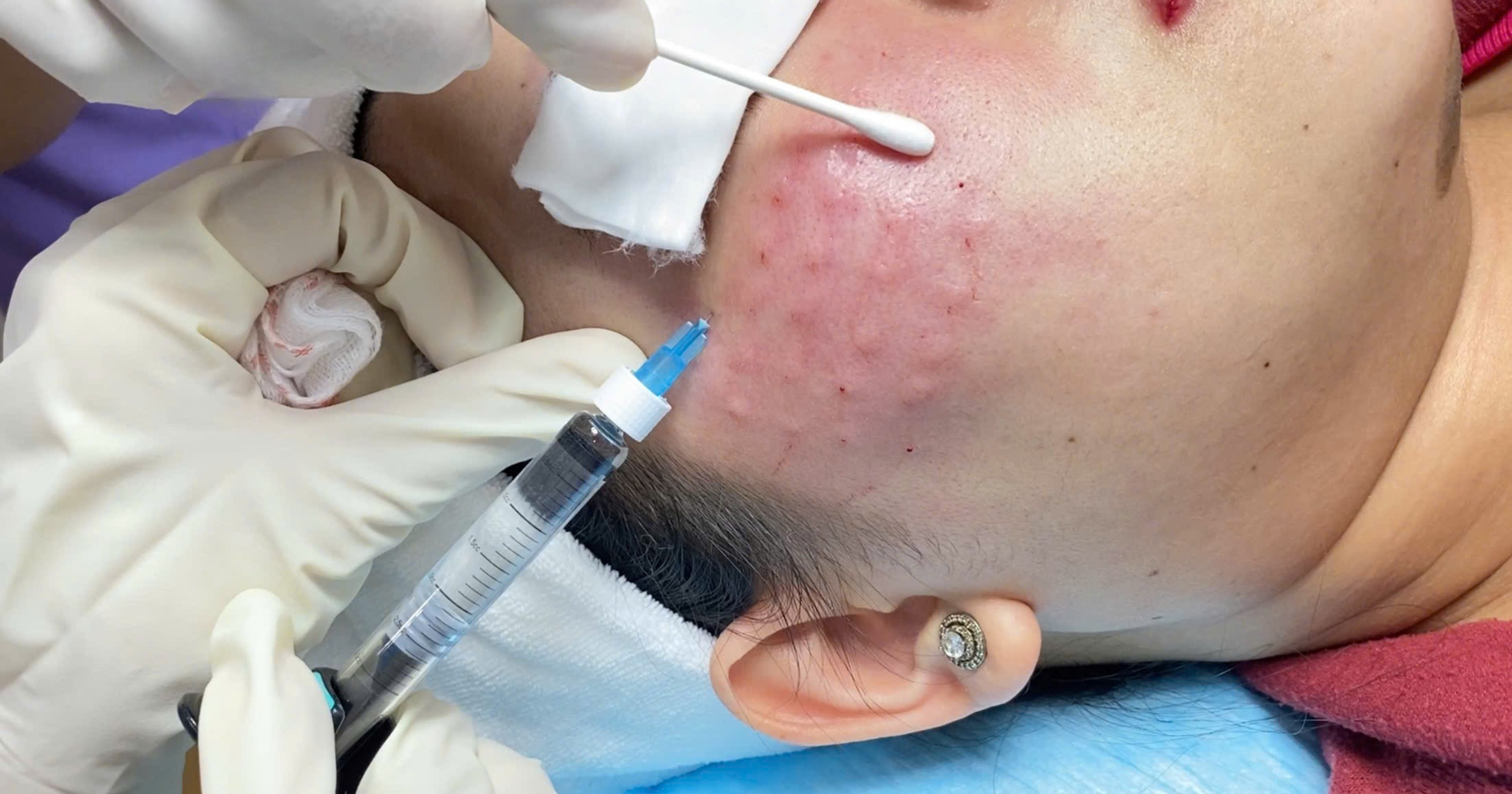 Trị thâm sau mụn nhanh cho da bị sạm lâu ngày