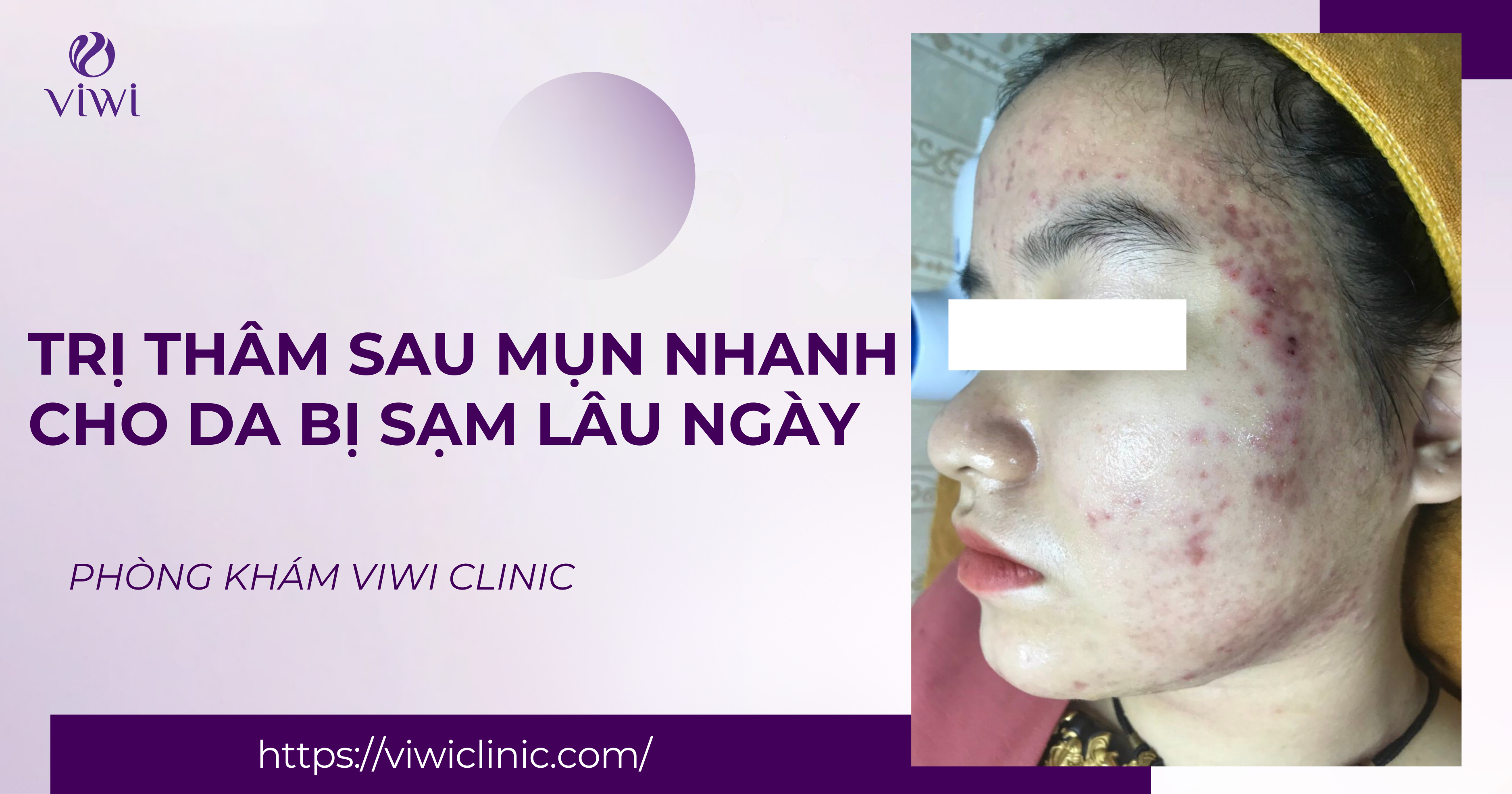 Trị thâm sau mụn nhanh cho da bị sạm lâu ngày