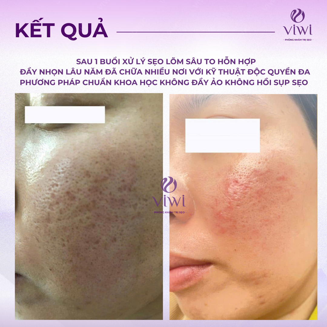 Sẹo rỗ lâu năm có trị hết hoàn toàn được không