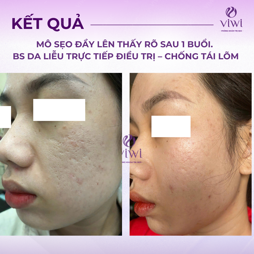 Sẹo rỗ lâu năm có trị hết hoàn toàn được không