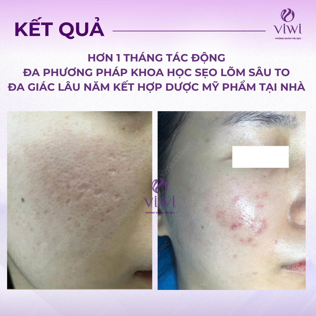 Sẹo rỗ lâu năm có trị hết hoàn toàn được không