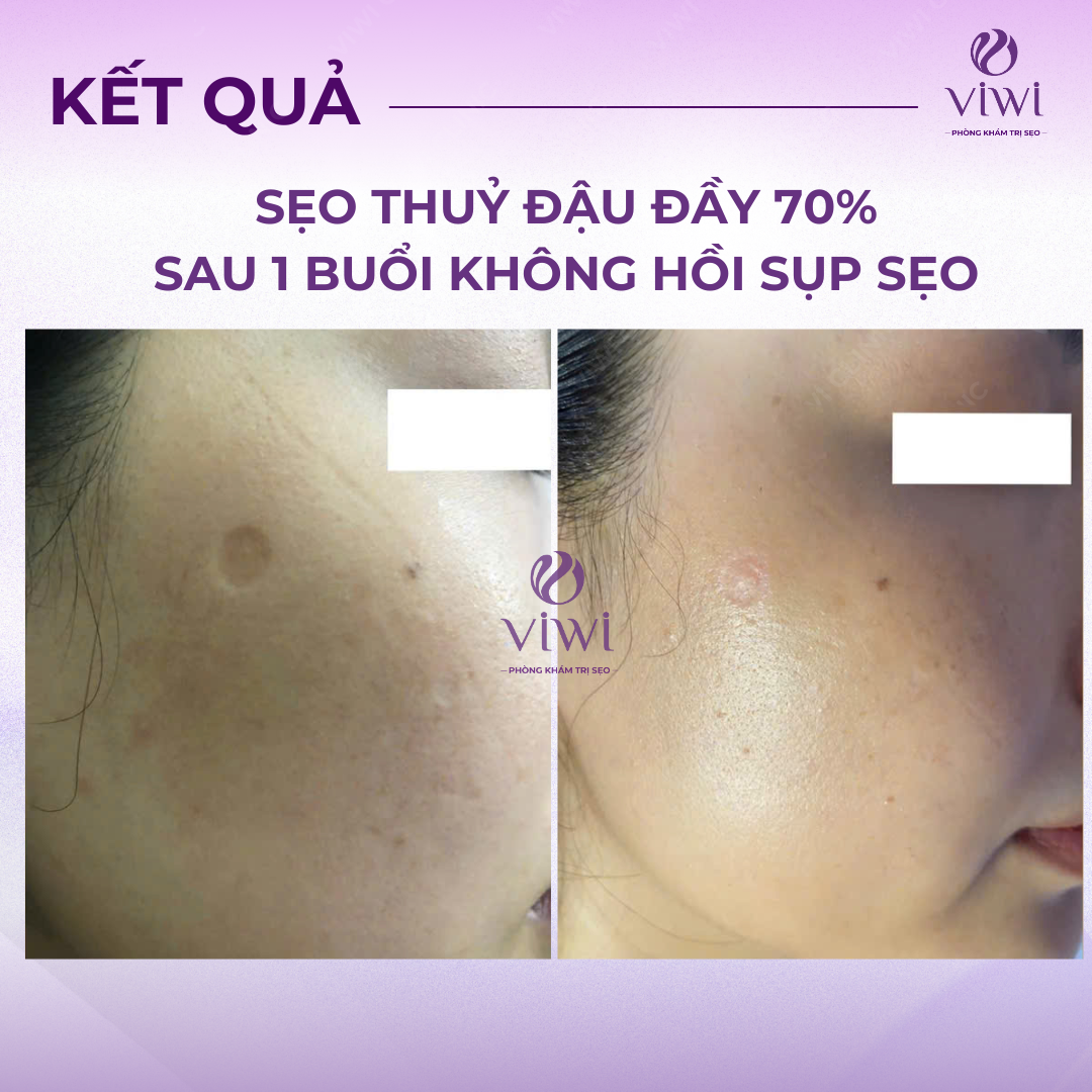 Sẹo rỗ lâu năm có trị hết hoàn toàn được không