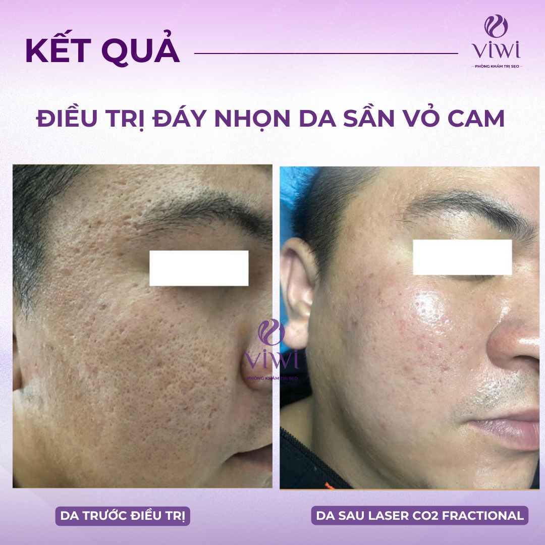 Sẹo rỗ lâu năm có trị hết hoàn toàn được không